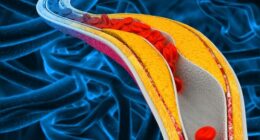 Having high cholesterol in the blood can lead to a buildup called "plaque" on the walls of the arteries, raising the risk of cardiovascular disease.