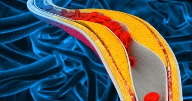 Having high cholesterol in the blood can lead to a buildup called "plaque" on the walls of the arteries, raising the risk of cardiovascular disease.