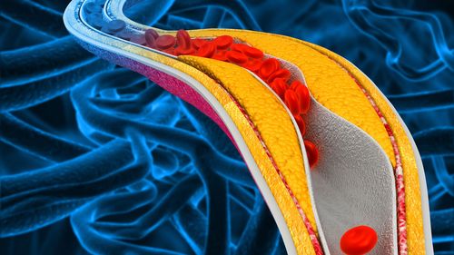 Having high cholesterol in the blood can lead to a buildup called "plaque" on the walls of the arteries, raising the risk of cardiovascular disease.