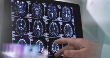 Heart test can show dementia risk up to 25 years before diagnosis