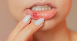 How can I get rid of these never-ending awful mouth ulcers? DR ELLIE has the answer