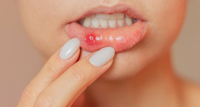 How can I get rid of these never-ending awful mouth ulcers? DR ELLIE has the answer