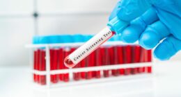 I'm a doctor and here are 6 symptoms of colon cancer you should never ignore