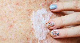 NHS approves revolutionary new treatment for debilitating skin condition which affects tens of thousands of people