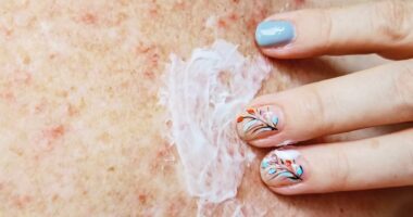 NHS approves revolutionary new treatment for debilitating skin condition which affects tens of thousands of people