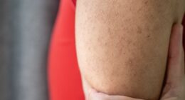 NHS issues advice on 'chicken skin' keratosis pilaris condition