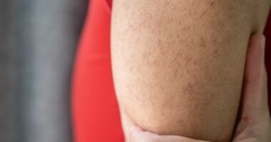 NHS issues advice on 'chicken skin' keratosis pilaris condition