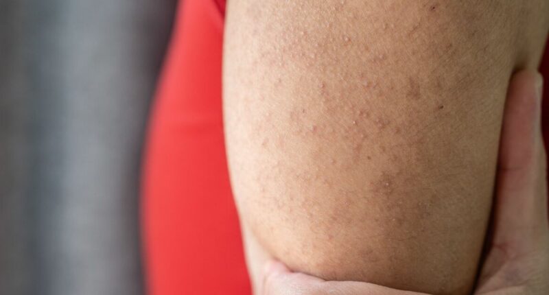 NHS issues advice on 'chicken skin' keratosis pilaris condition