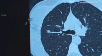 Northwestern Medicine Chicago study recommends expanded lung cancer screenings for younger ages, women