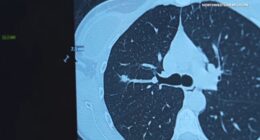 Northwestern Medicine Chicago study recommends expanded lung cancer screenings for younger ages, women