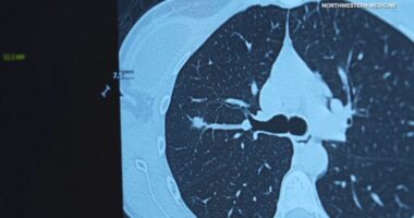 Northwestern Medicine Chicago study recommends expanded lung cancer screenings for younger ages, women