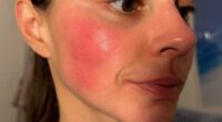 Rosacea blighted my life for years, until this fix cleared it for good