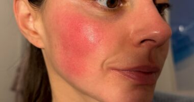 Rosacea blighted my life for years, until this fix cleared it for good