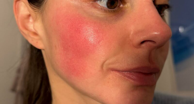 Rosacea blighted my life for years, until this fix cleared it for good