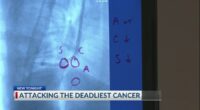 Savannah doctors use unique robotic technology to pinpoint lung cancer