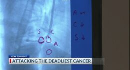 Savannah doctors use unique robotic technology to pinpoint lung cancer