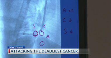 Savannah doctors use unique robotic technology to pinpoint lung cancer