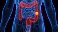 Scientists pinpoint bowel cancer's 'Big Bang' moment, prompting hopes for new life-saving treatment