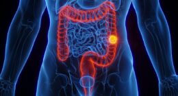 Scientists pinpoint bowel cancer's 'Big Bang' moment, prompting hopes for new life-saving treatment