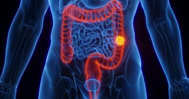 Scientists pinpoint bowel cancer's 'Big Bang' moment, prompting hopes for new life-saving treatment