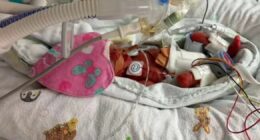 'I couldn't choose which of my twins would live when doctors asked'