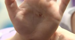 Children suffer burns on waterslide at NZ daycare after chemical 'mix-up'