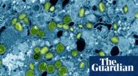 England health officials identify newly evolved strain of mpox