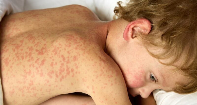 Experts worry about spread of measles... as new 'super' virus rises
