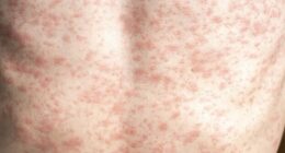 Giroir: RFK Jr. Needs to 'Unconditionally' Advocate for Measles Vaccine, Lack of Vaccination Causing Deaths, Outbreak