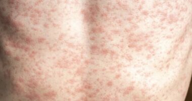 Giroir: RFK Jr. Needs to 'Unconditionally' Advocate for Measles Vaccine, Lack of Vaccination Causing Deaths, Outbreak