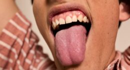 Two signs in your mouth that could mean a vitamin B12 deficiency