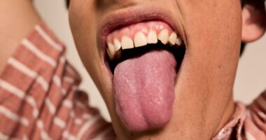 Two signs in your mouth that could mean a vitamin B12 deficiency