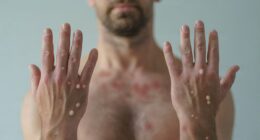 US records new case of mpox in American traveler... putting tens of thousands at risk of exposure