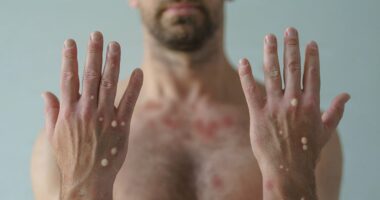 US records new case of mpox in American traveler... putting tens of thousands at risk of exposure