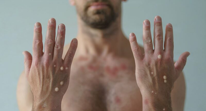 US records new case of mpox in American traveler... putting tens of thousands at risk of exposure