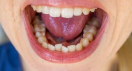 7 reasons you have a 'metallic ' taste in mouth and how to get rid of it