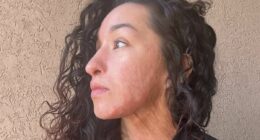 Acid attack survivor reveals details of horrendous assault