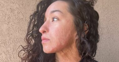 Acid attack survivor reveals details of horrendous assault