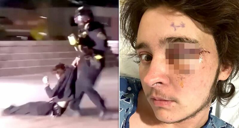 Anti-ICE protester blinded after being shot by projectile at protest