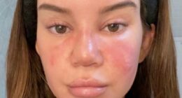 Country star suffered face-swelling 'sinus infection' before NYE show