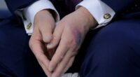 The large black and red bruise seen on Donald Trump's hand.