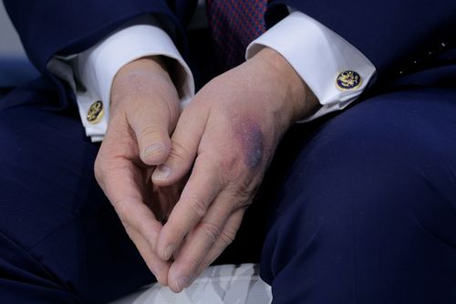 The large black and red bruise seen on Donald Trump's hand.