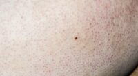 I've discovered red spots on my arms and I've no idea where they've come from - should I be worried? DR PHILIPPA KAYE reveals the unsightly and uncurable skin condition to blame... and why it's on the rise