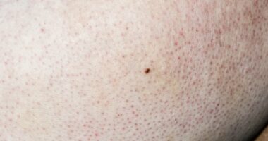 I've discovered red spots on my arms and I've no idea where they've come from - should I be worried? DR PHILIPPA KAYE reveals the unsightly and uncurable skin condition to blame... and why it's on the rise