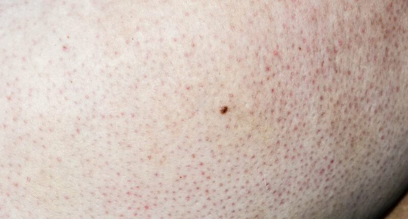 I've discovered red spots on my arms and I've no idea where they've come from - should I be worried? DR PHILIPPA KAYE reveals the unsightly and uncurable skin condition to blame... and why it's on the rise