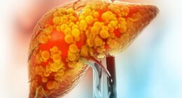 Keto diet warning as plan is linked to increased risk of liver cancer in disturbing new study