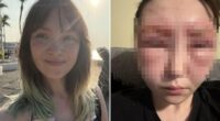 My eyes swelled shut after I had a terrifying reaction to popular eyebrow tinting treatment