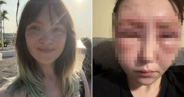My eyes swelled shut after I had a terrifying reaction to popular eyebrow tinting treatment