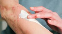 The 5 shingles red flags to know as rashes ‘surge by 50%’