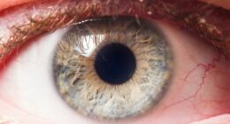 The silent blindness epidemic: Glaucoma cases soar as millions go undiagnosed